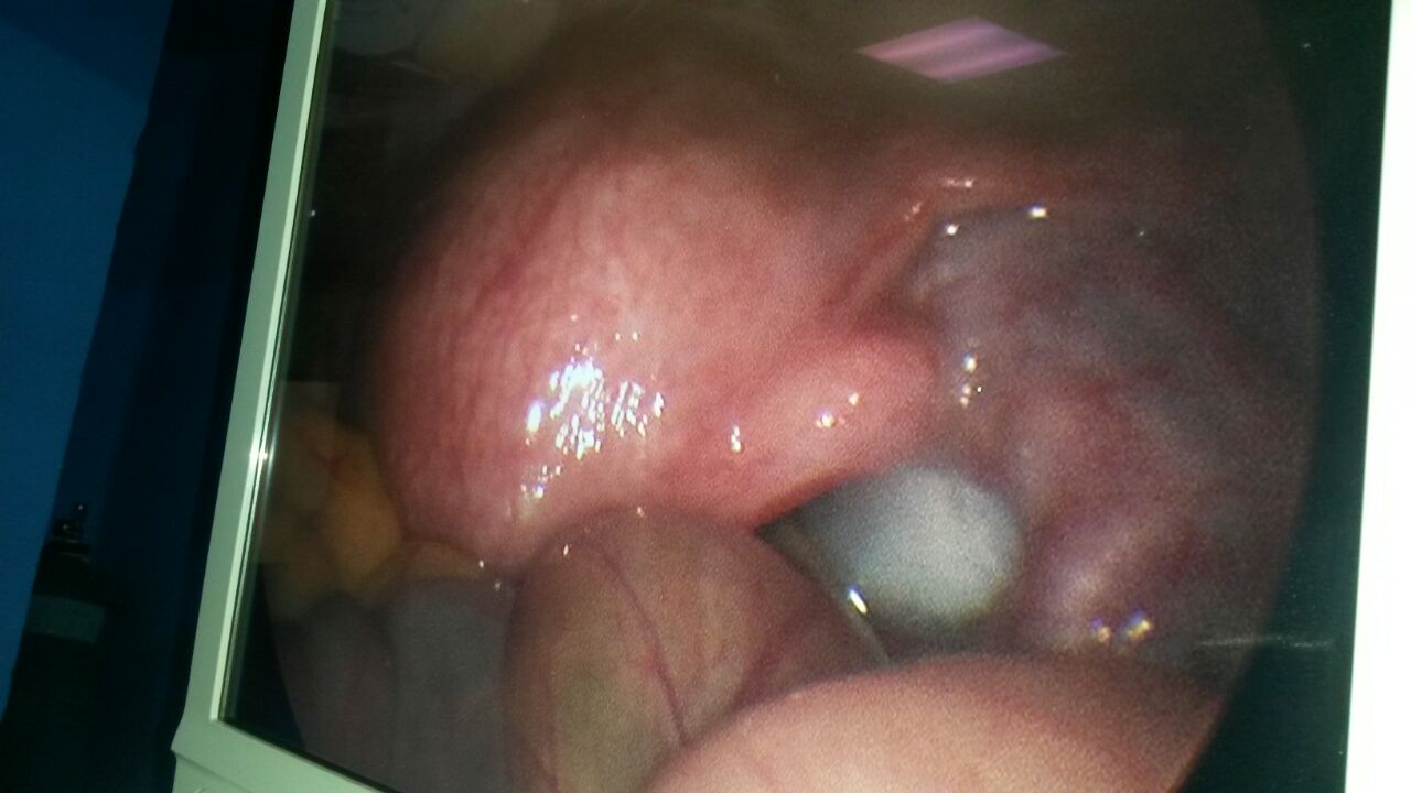 Infertility treatment at Pushp gynae, Indore.