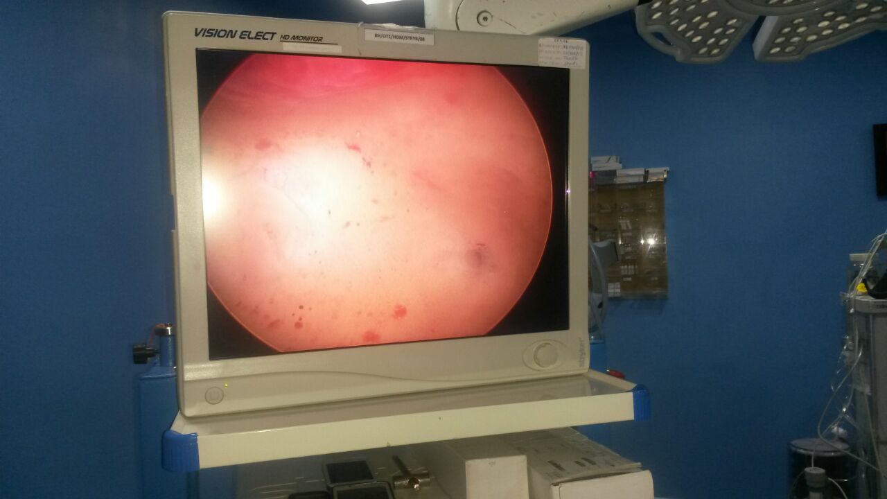 Infertility treatment at Pushp gynae, Indore.