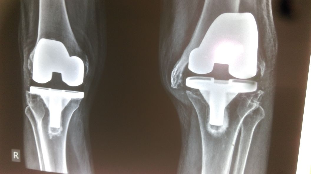 Revision Bilateral Total Knee Replacement at Pushp Orthopaedics Centre, Indore