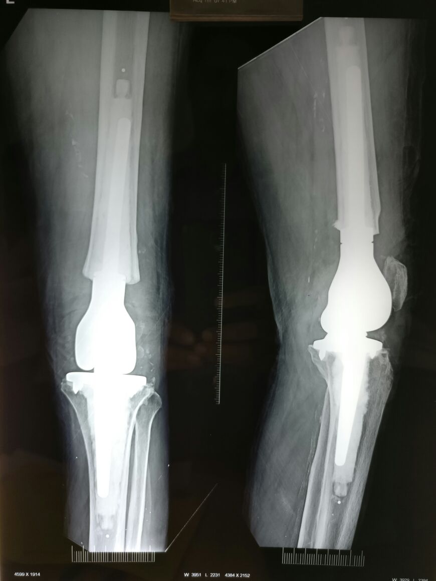 Revision Bilateral Total Knee Replacement at Pushp Orthopaedics Centre, Indore