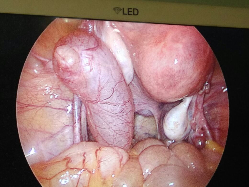 Laparoscopic hysterectomy (scarless,key hole surgery) at pushp gynae, Indore