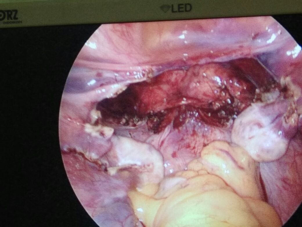 Laparoscopic hysterectomy (scarless,key hole surgery) at pushp gynae, Indore