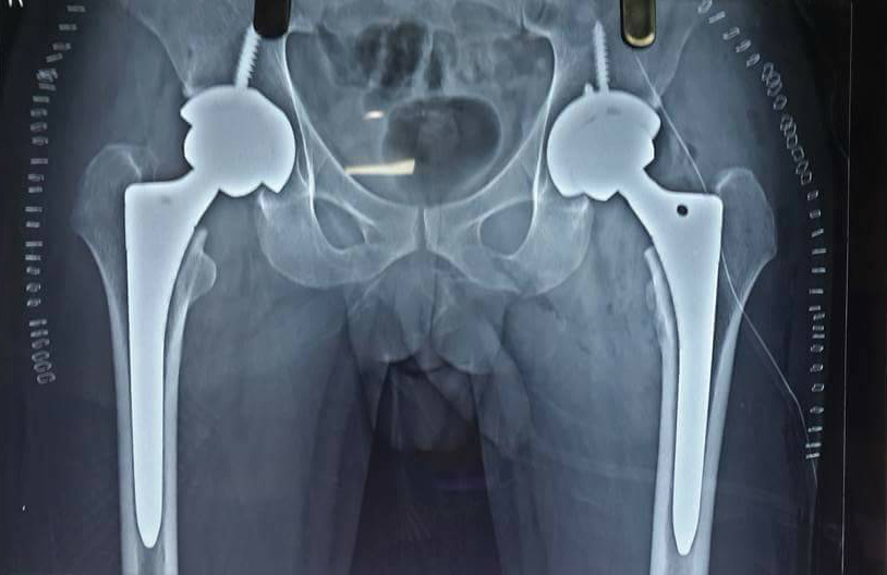 Bilateral hip avascular necrosis patient- operated bilateral total hip replacement in Indore