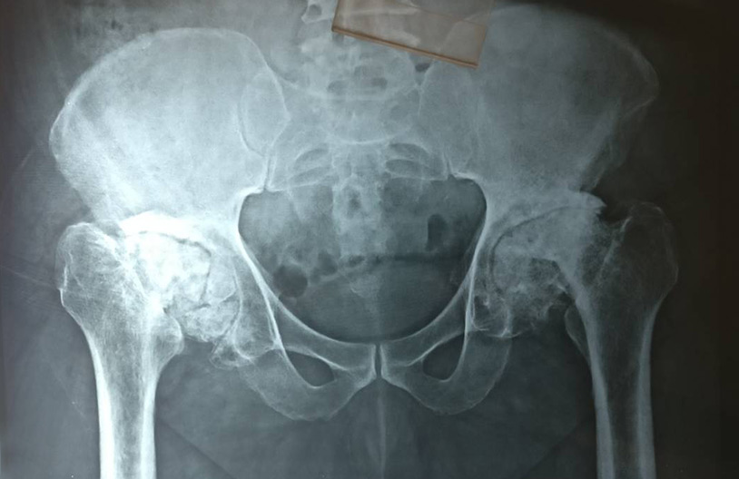 Bilateral hip avascular necrosis patient- operated bilateral total hip replacement in Indore
