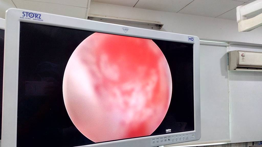 Hysteroscopy by Dr Sheela Chhabra at Pushp Gynae Centre, Indore