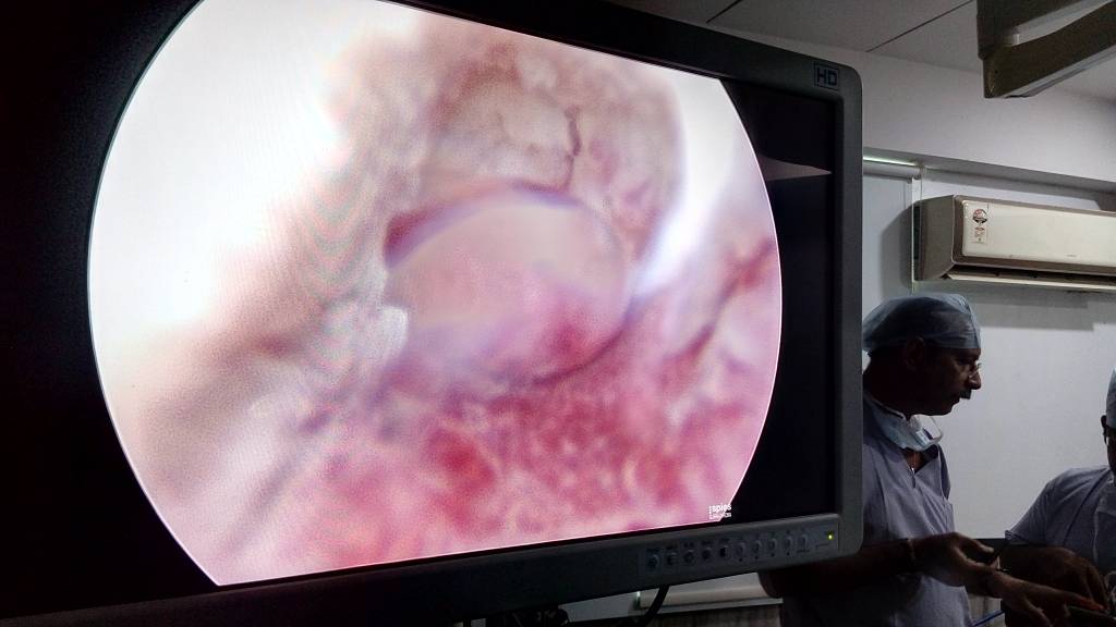 Hysteroscopy by Dr Sheela Chhabra at Pushp Gynae Centre, Indore