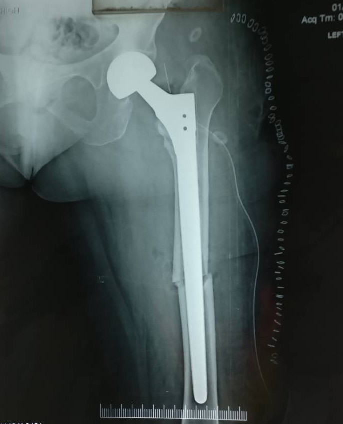 Successful revision partial Hip Replacement surgery patient from Neemuch