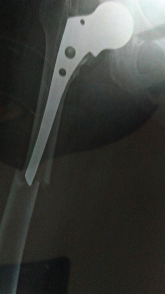 Successful revision partial Hip Replacement surgery patient from Neemuch