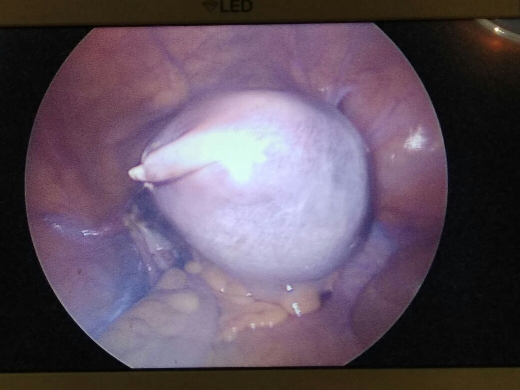Laparoscopic Hysterectomy at Pushp Gynae Centre, Indore