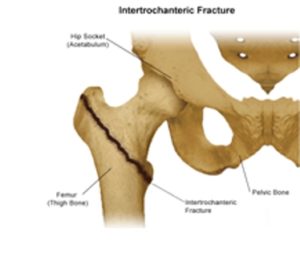 Hip Replacement Surgeon Indore 