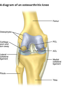 Knee Replacement in Indore 