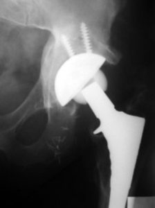 Hip Replacement Surgeon Indore 