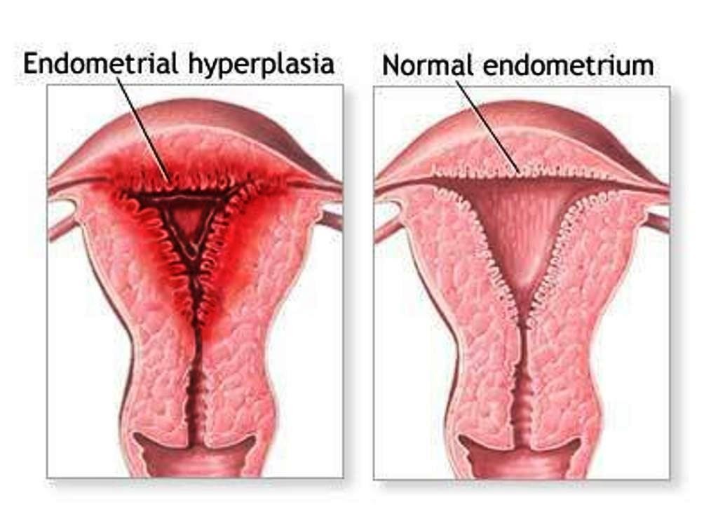 Heavy Periods? Know What You Should Do