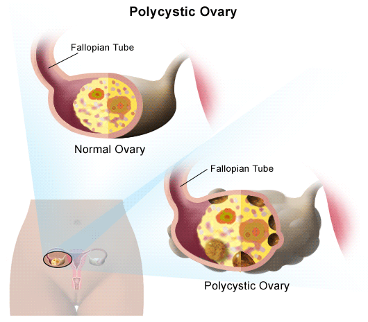 What is PCOS?